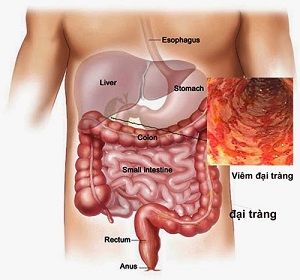 Cơ thể người bệnh đau đại tràng