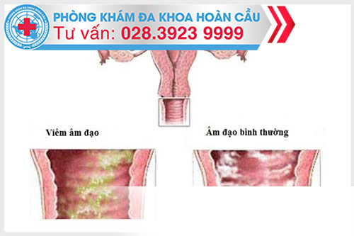 Liên hệ tư vấn chữa viêm âm đạo